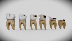 Tooth Decay Progression (Dental Caries)