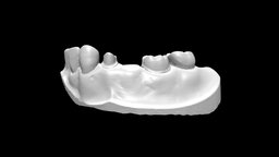 Fixed Partial Denture(#19FGC & #21MCC)-Preview
